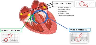 Long-Term Follow-Up In Paroxysmal Atrial Fibrillation Patients With Documented Isolated Trigger